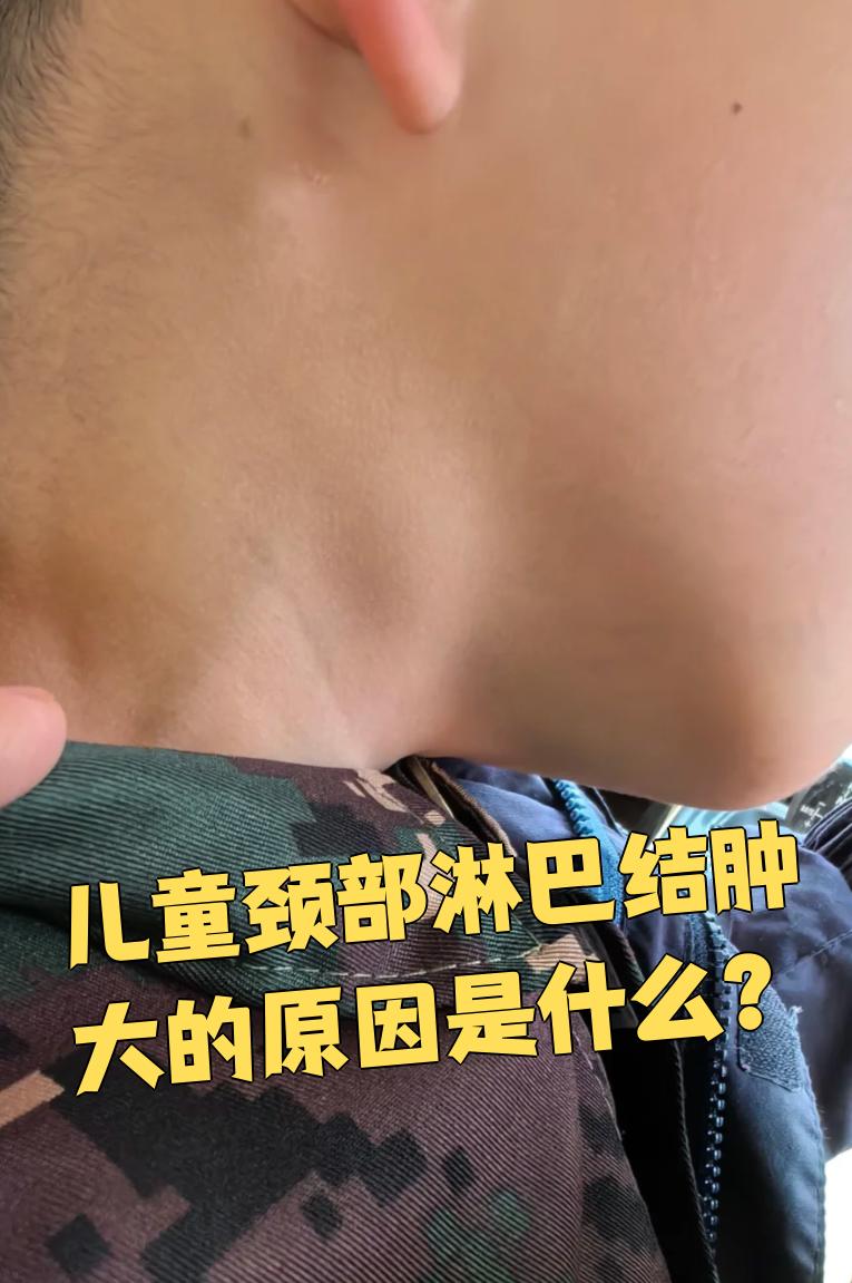 如何治疗少儿的淋巴结炎.