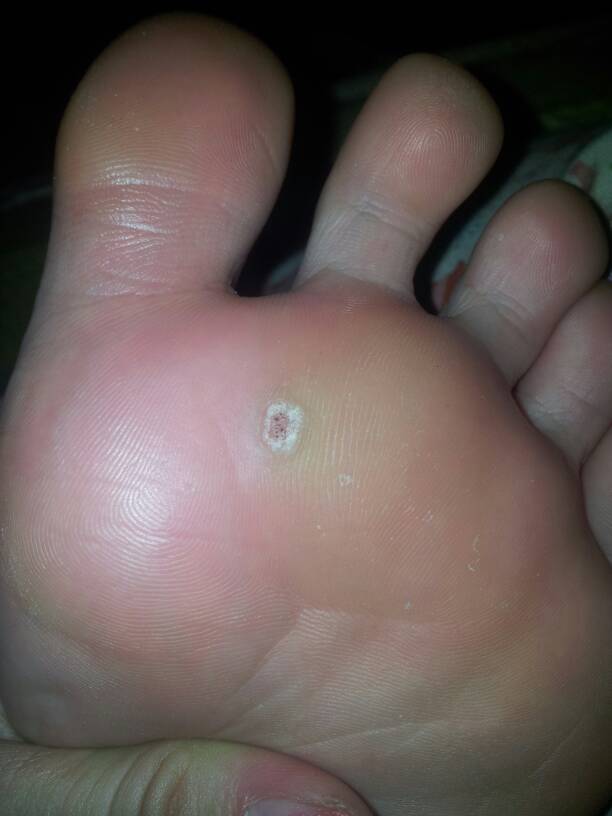 脚底的皮一个洞一个洞的