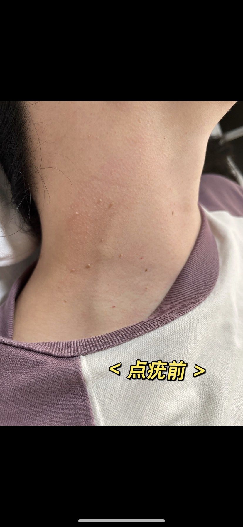 脖子上长了疣,怎么办?