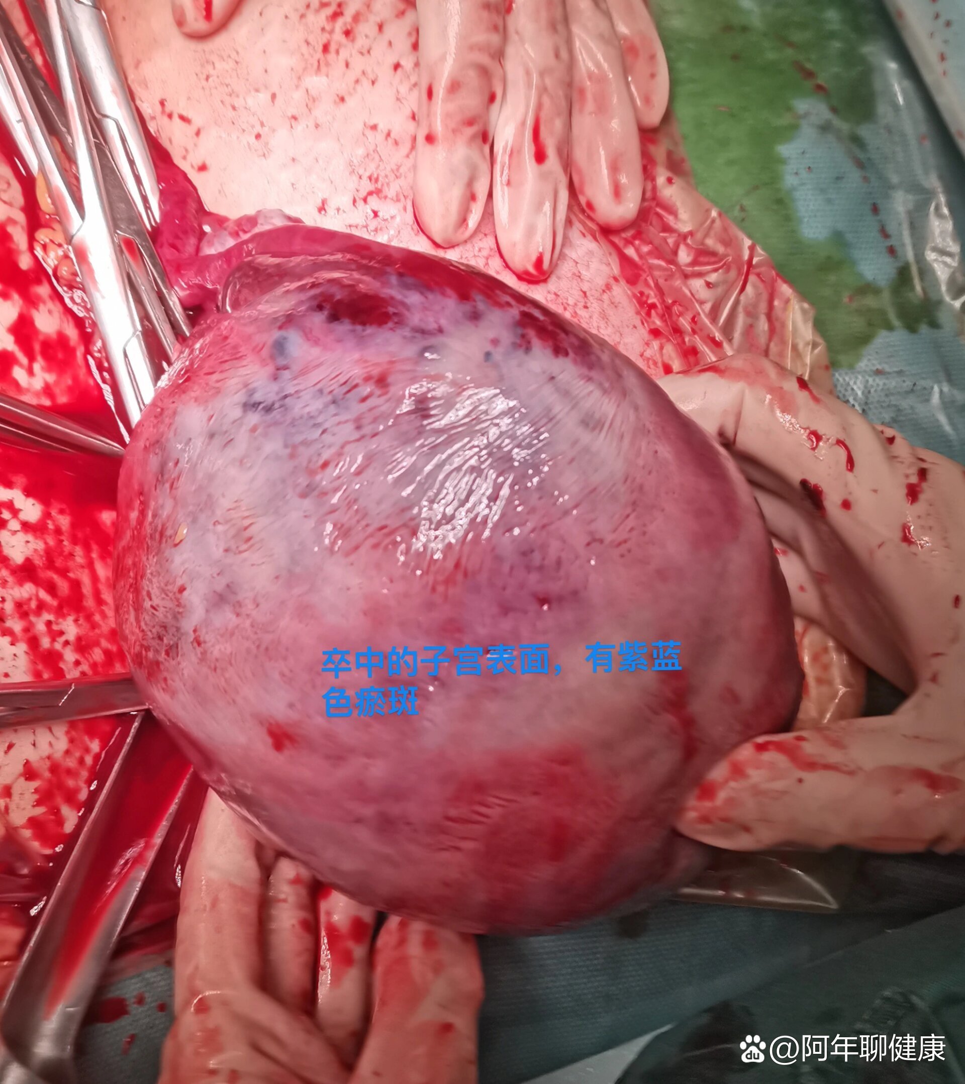 胎盘早剥是什么意思