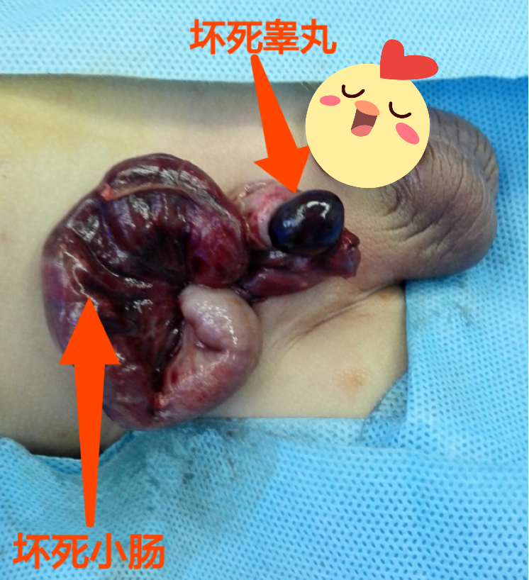 睾丸疝气可以自愈吗