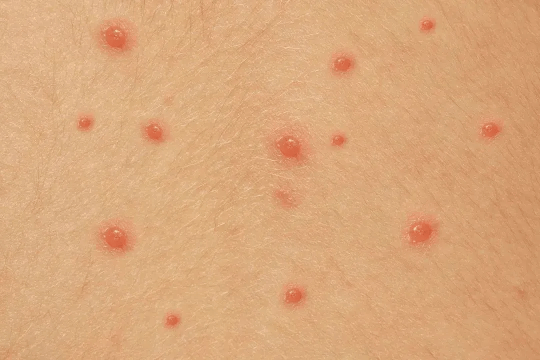 水痘的症状有哪些