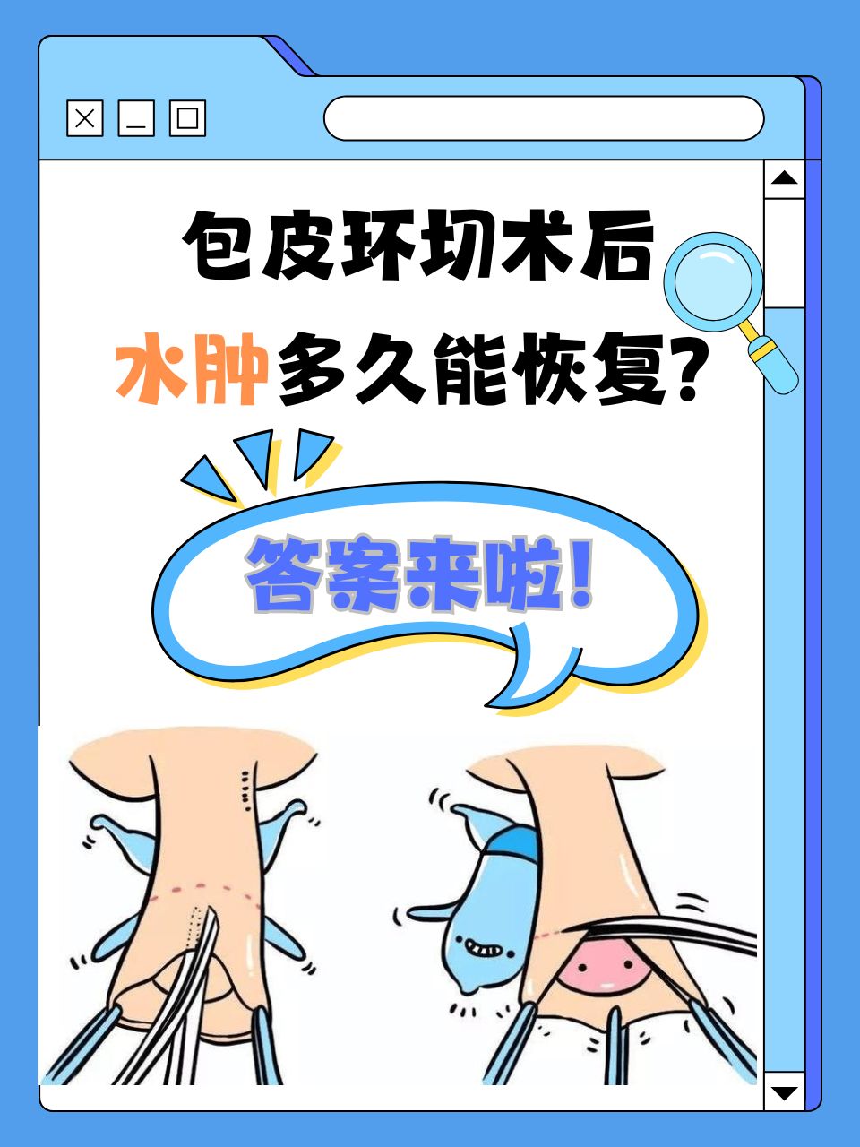 今天包皮手术七天了,还裹着绷带