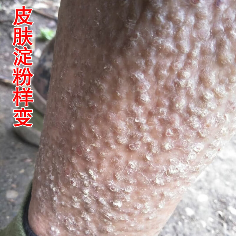 皮肤淀粉样变怎么治疗?