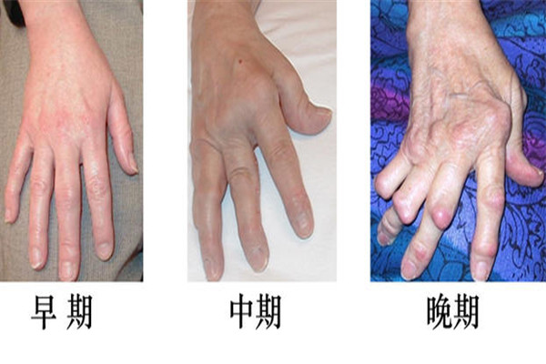 手指水肿怎么办?