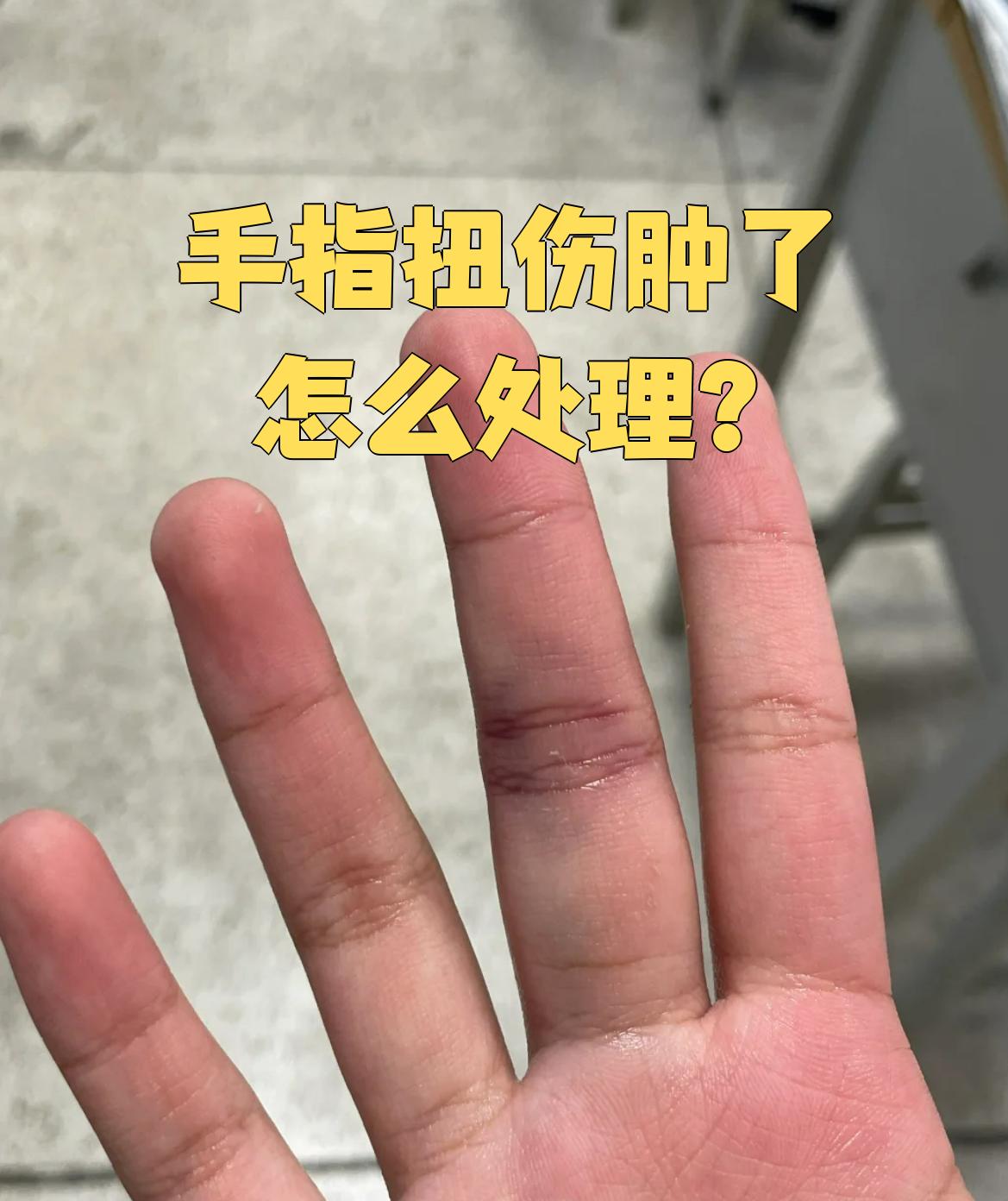 手指水肿怎么办?