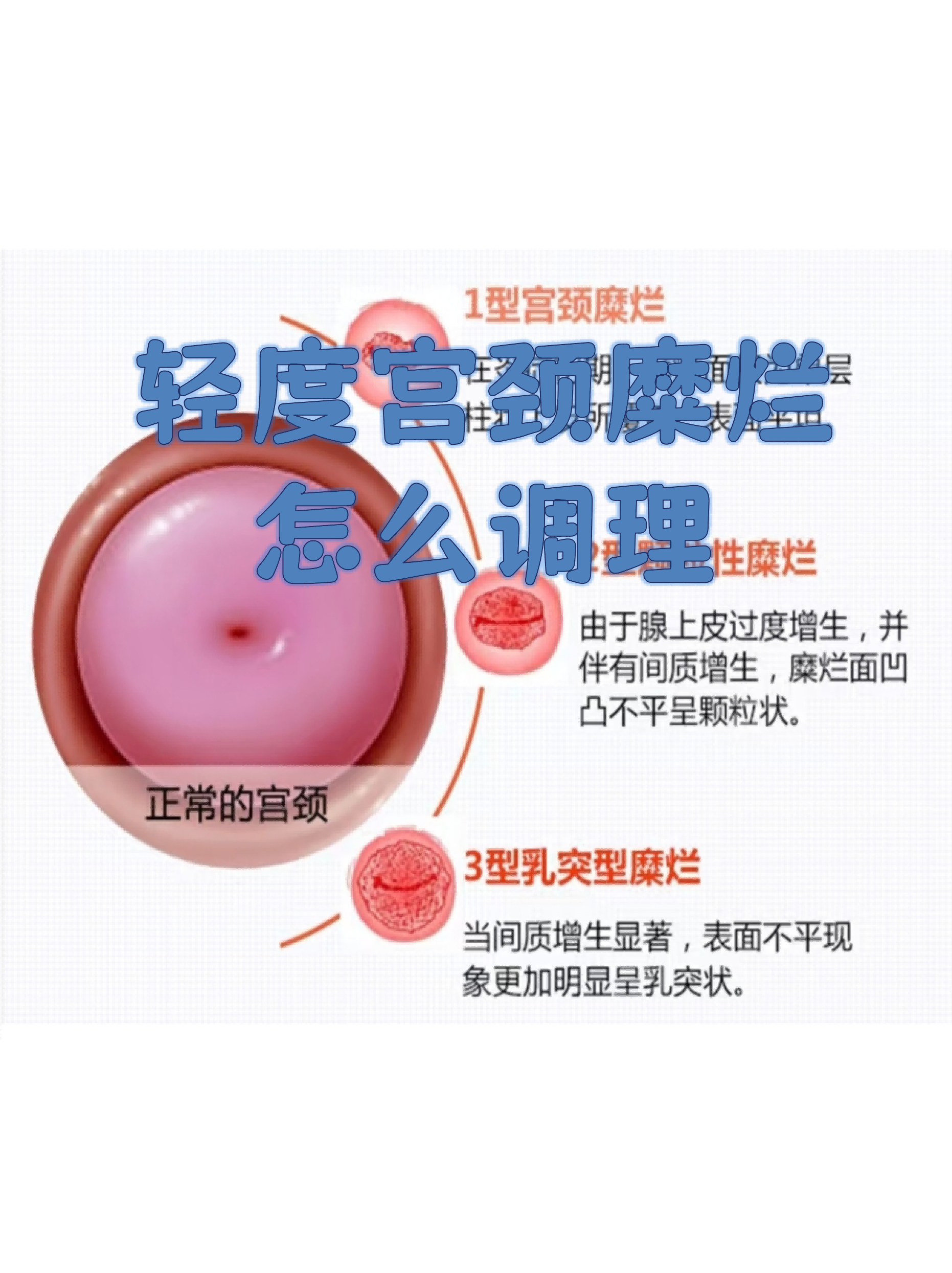 中度宫颈糜烂如何治疗