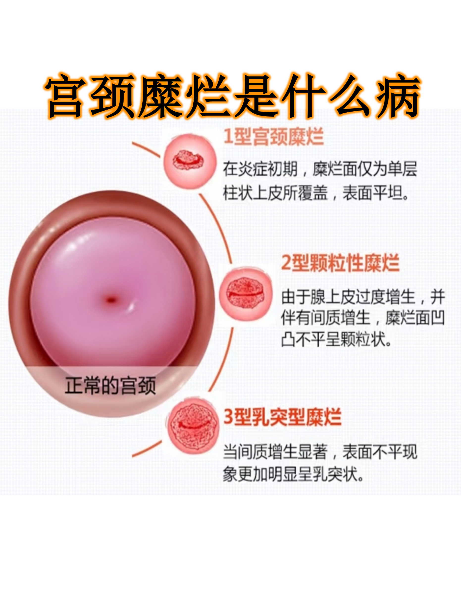 中度宫颈糜烂如何治疗