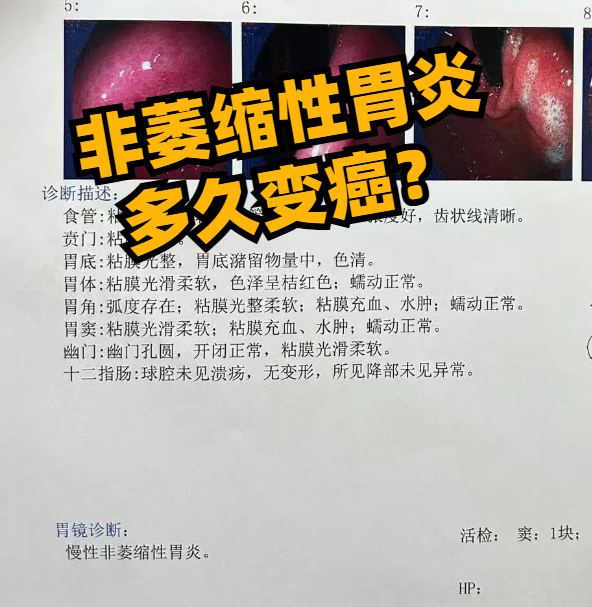 非萎缩性胃炎是什么意思?