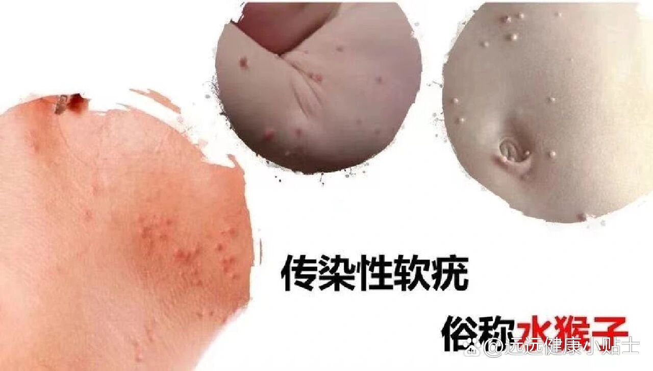 什么是传染性软疣