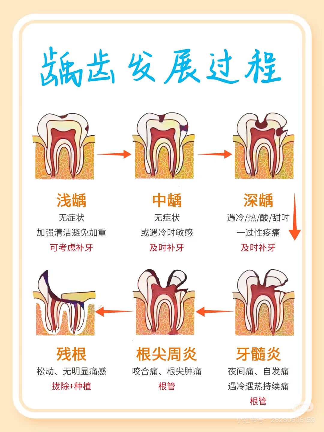 龋齿是一种传染病吗?