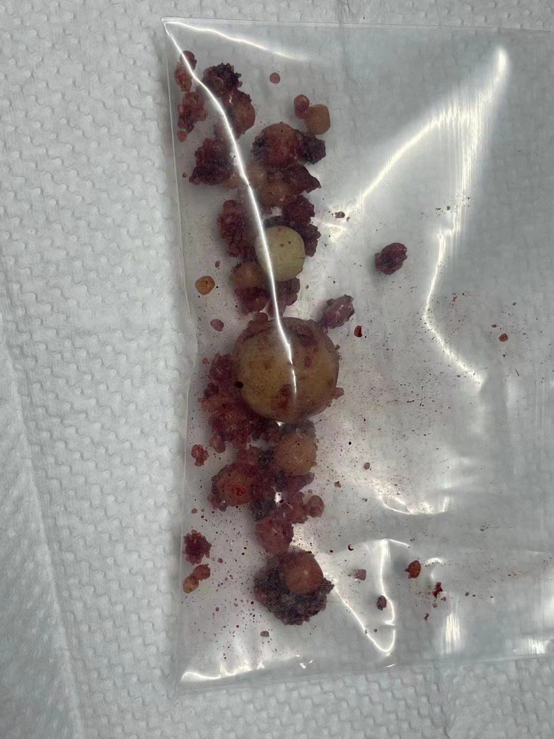 什么是泌尿系结石