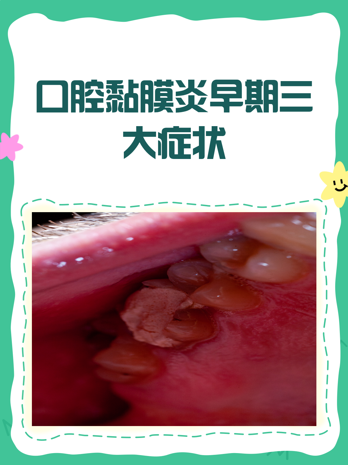 口腔粘膜脱落怎么回事
