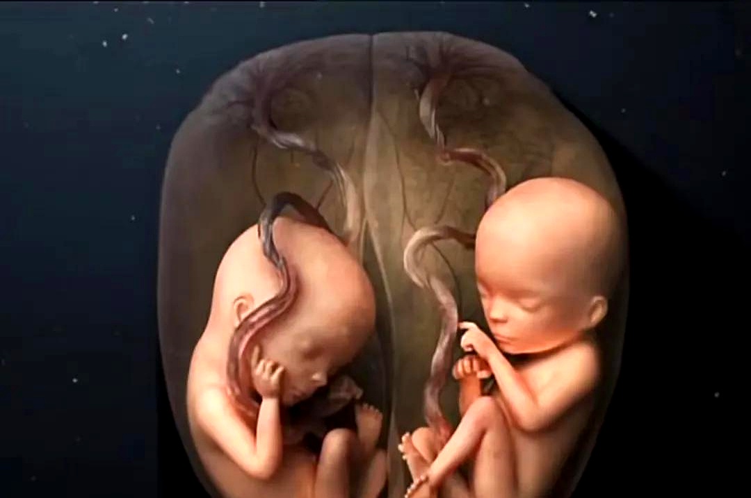 怀双胞胎的早期症状有哪些?