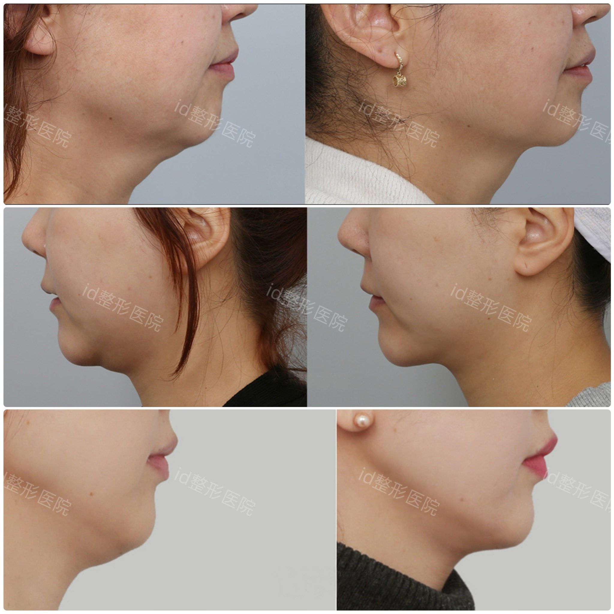 溶脂针瘦脸可以吗?