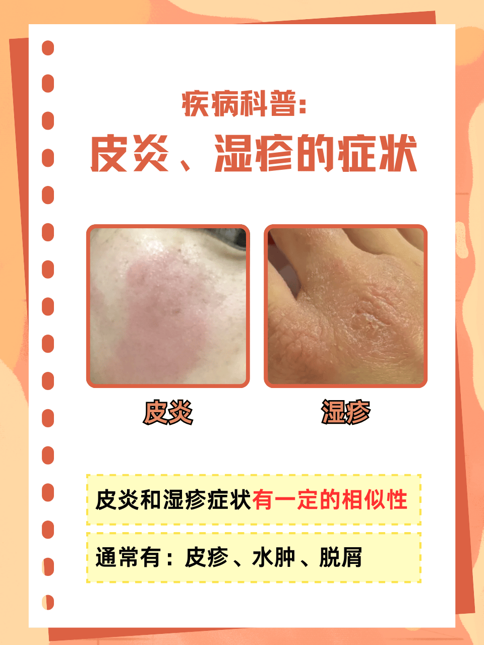 湿疹是什么原因引起的呢