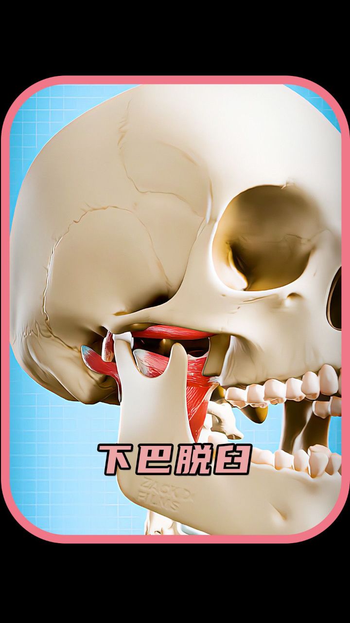 下巴脱臼怎么治疗?