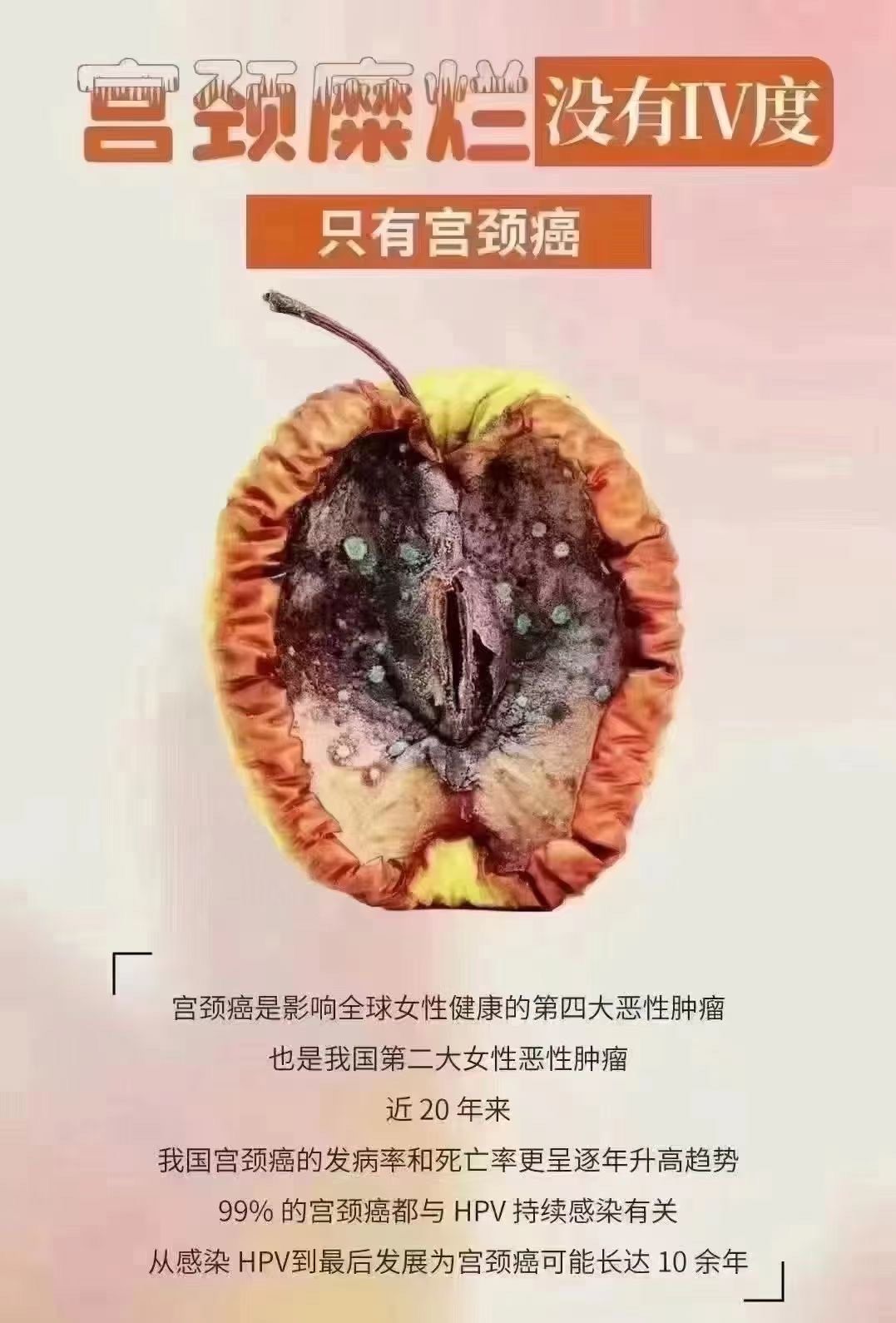 宫颈糜烂手术后会复发吗?