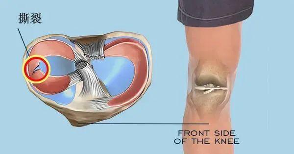 半月板切除对身体影响