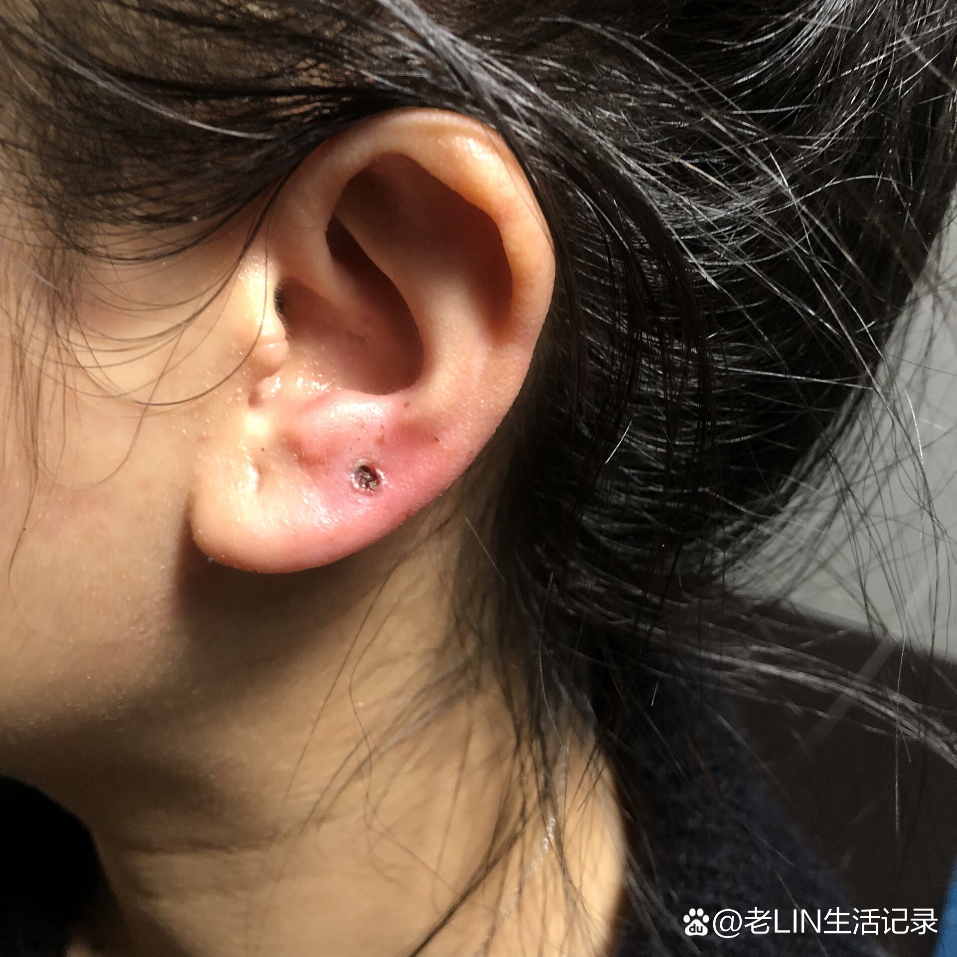 刚打完耳洞肿了,很疼,怎么办?