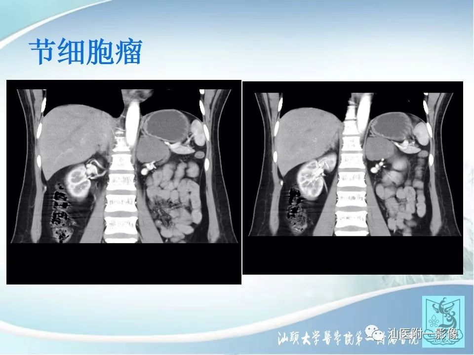 嗜铬细胞瘤的症状