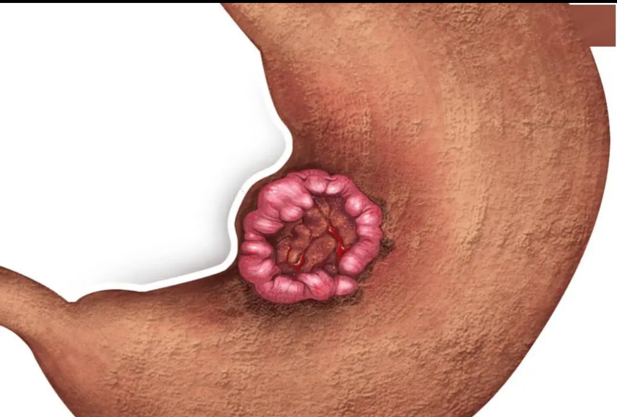 嗜铬细胞瘤的症状