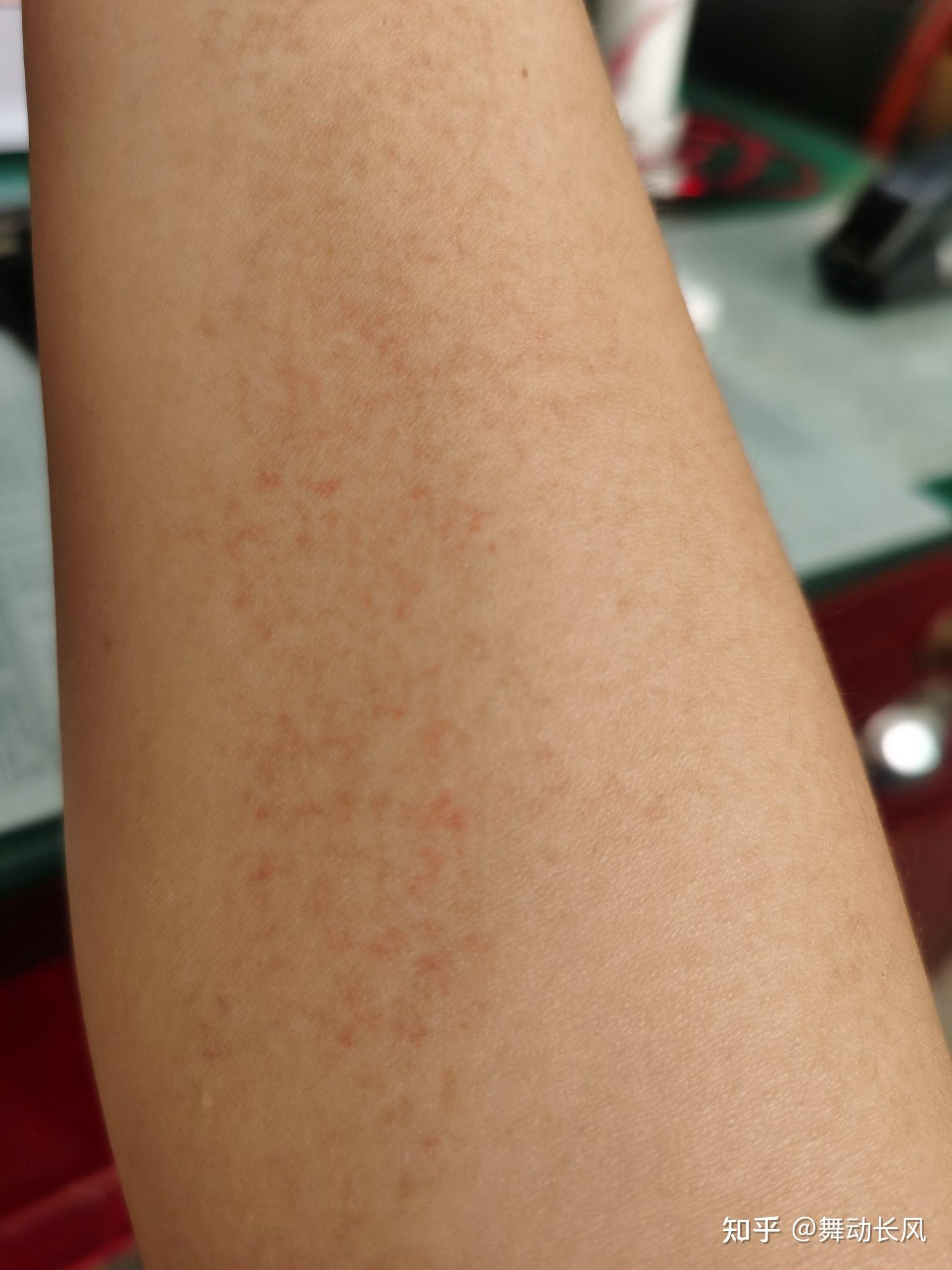 身上有小红点不痛也不痒