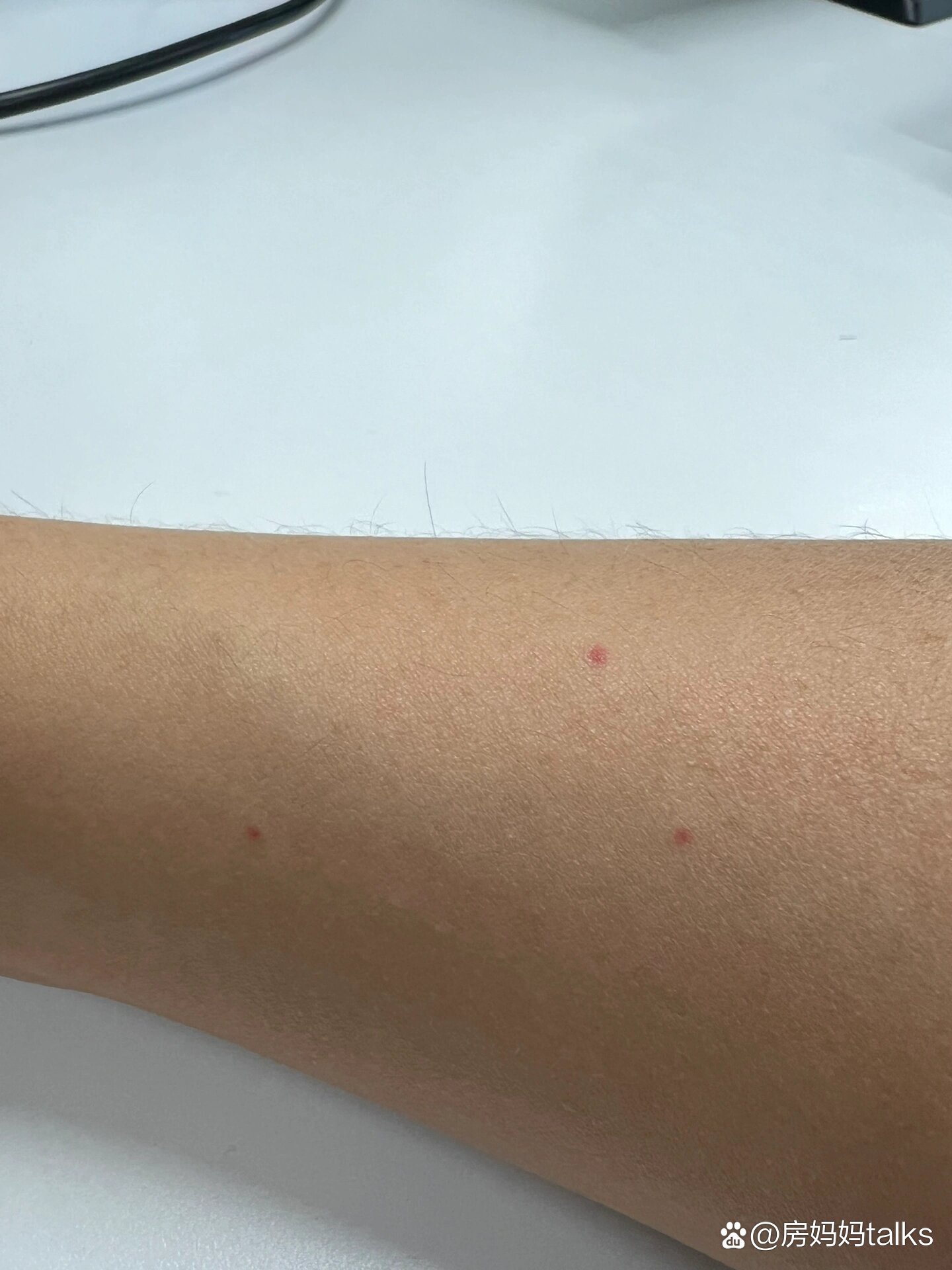 身上有小红点不痛也不痒