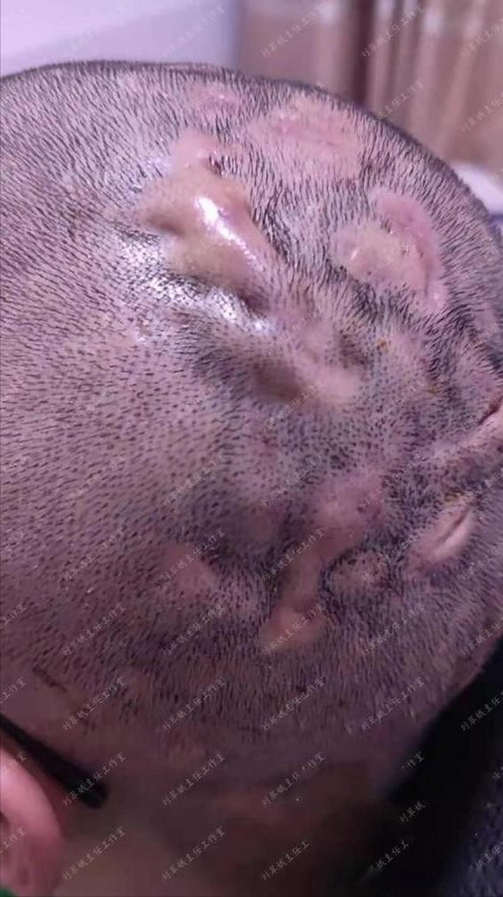 后脑勺头上反复长脓包