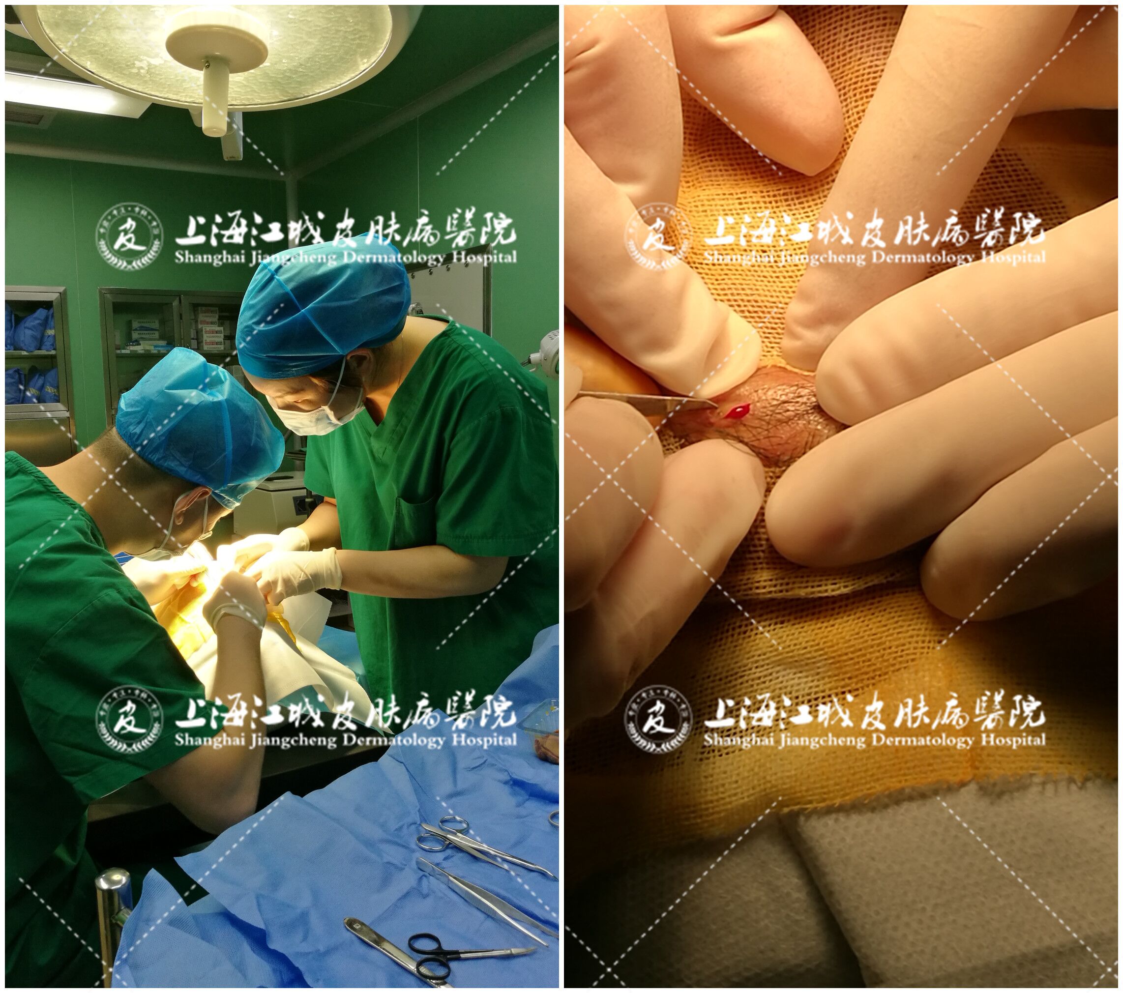 皮脂腺囊肿有手术必要吗?