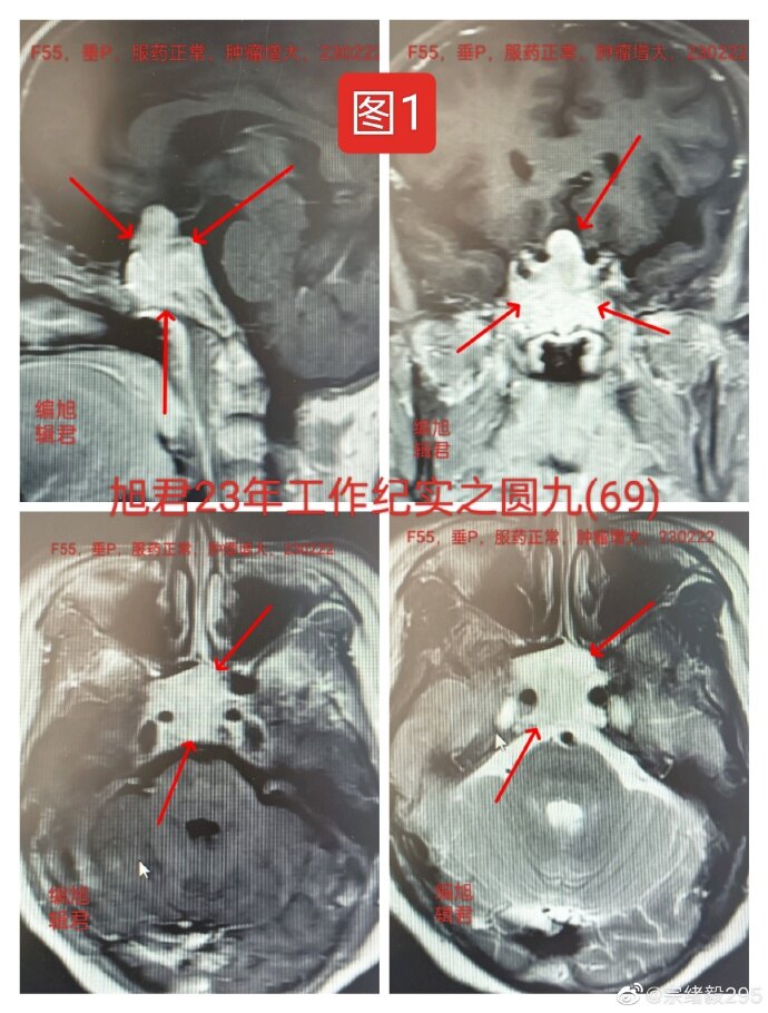 什么是泌乳素瘤?