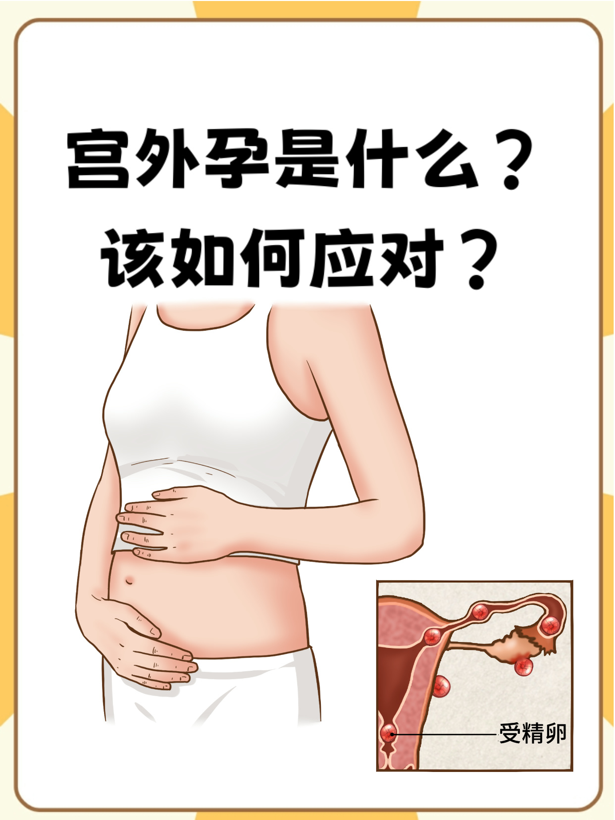 宫外孕有哪些症状初期