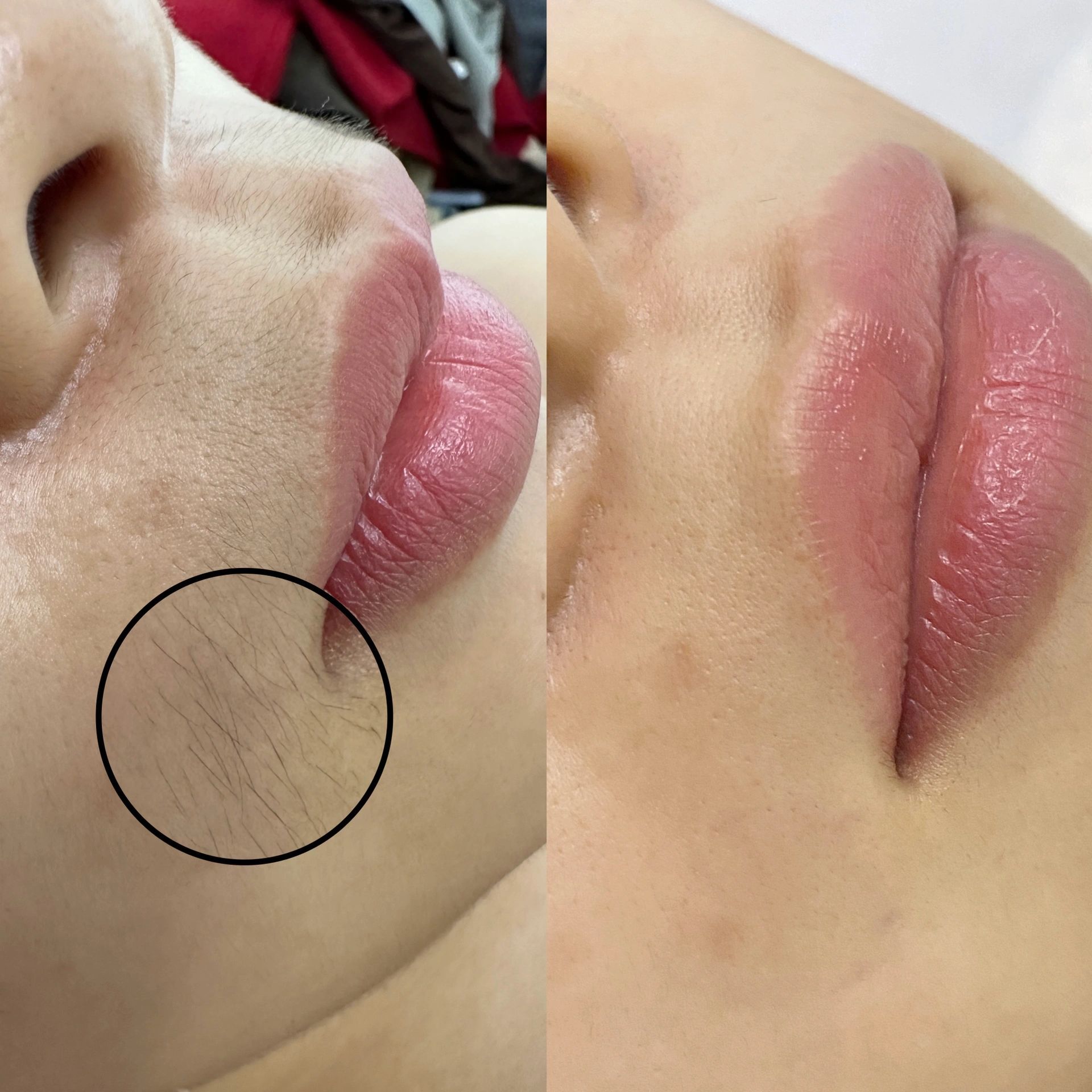 冰点脱毛是永久的吗?