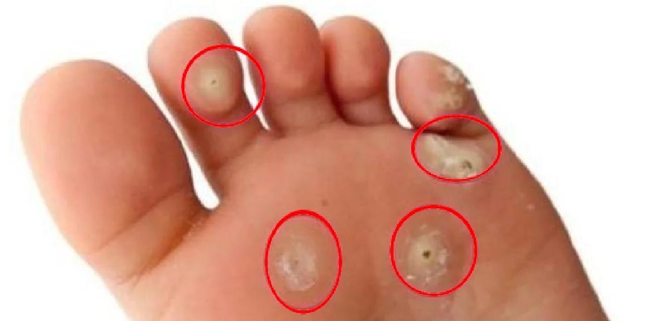 为什么手上会长鸡眼