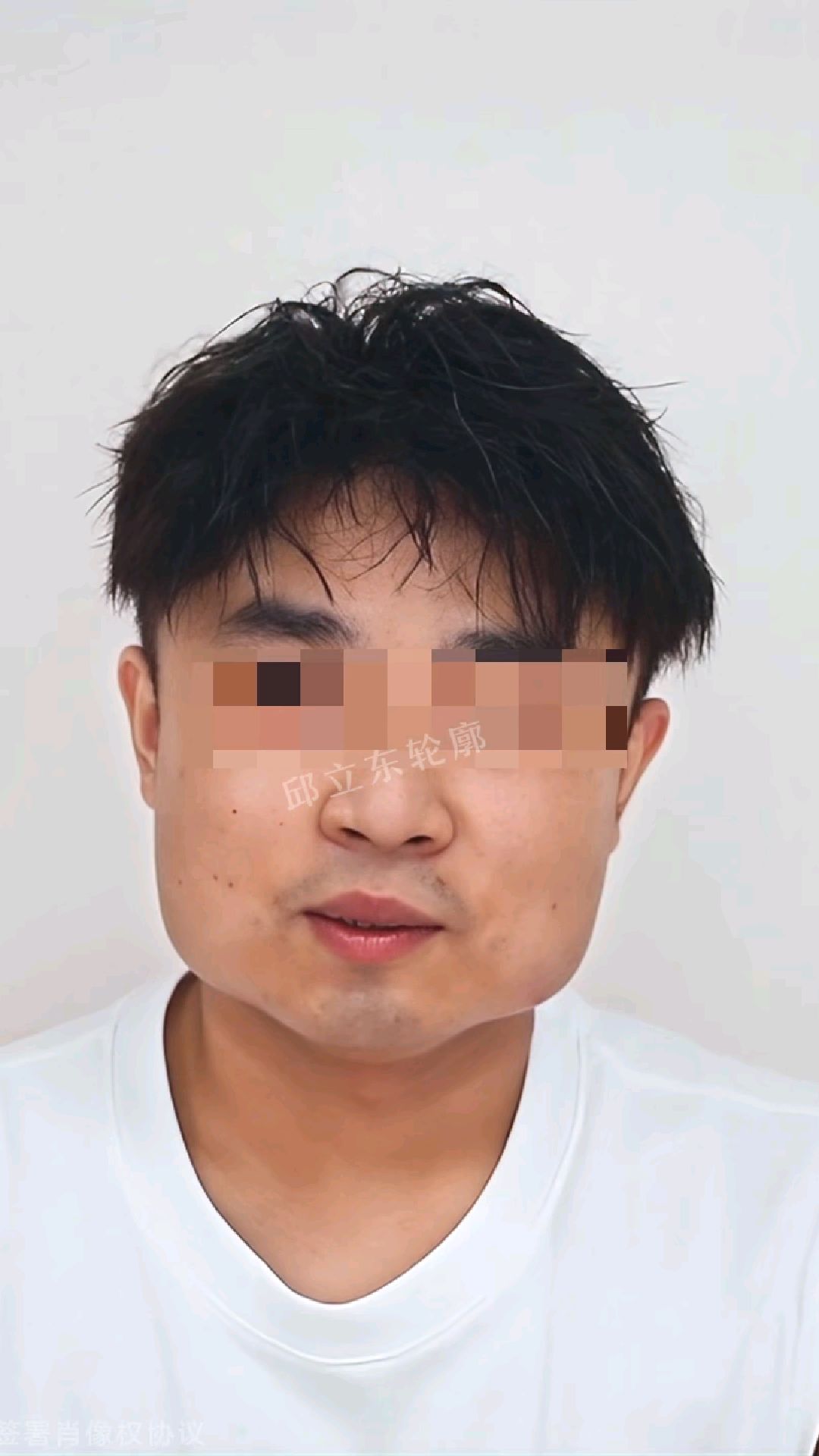 方形脸咬肌肥大下颌角肥大