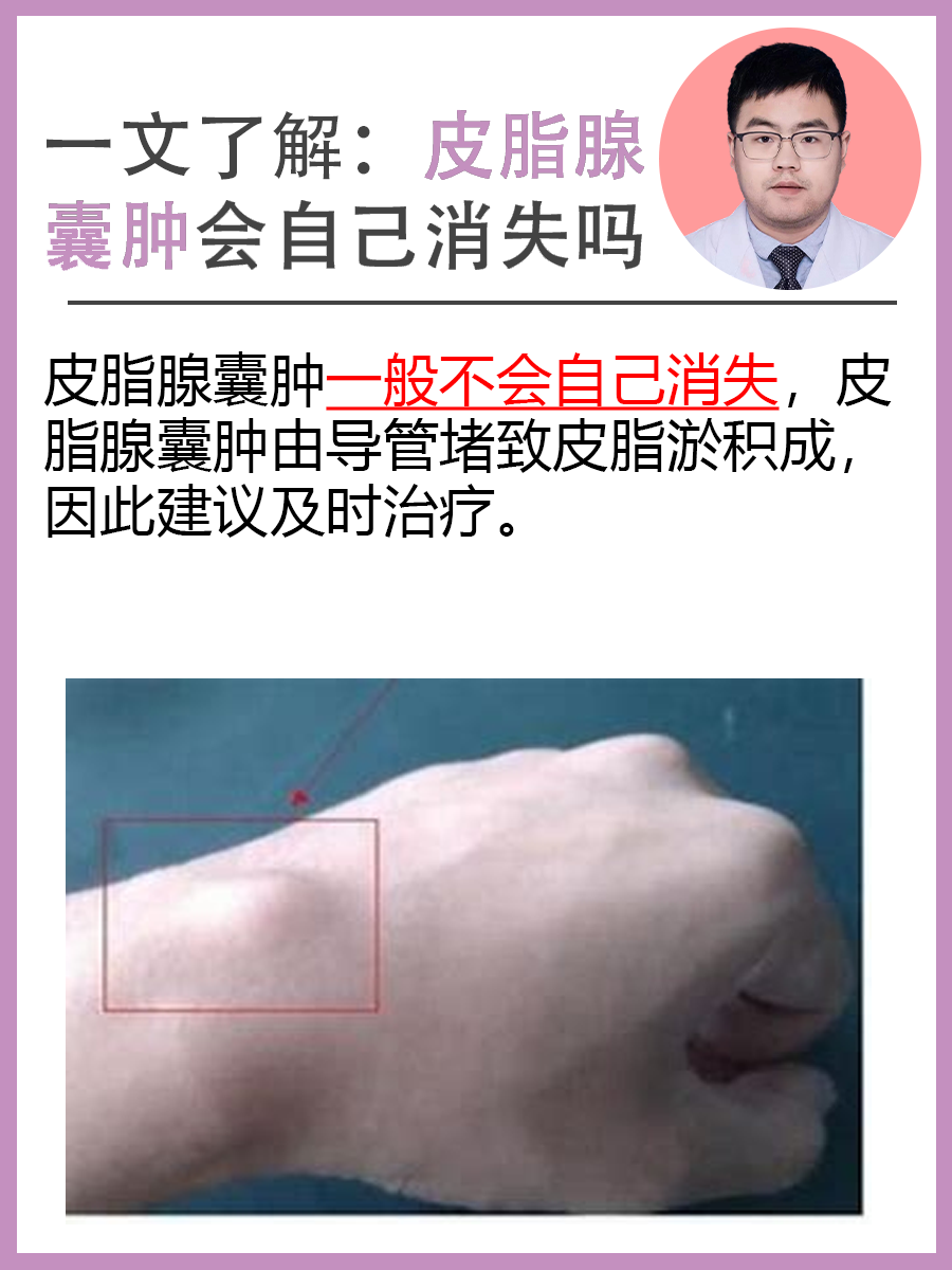 皮脂腺瘤是怎么回事?