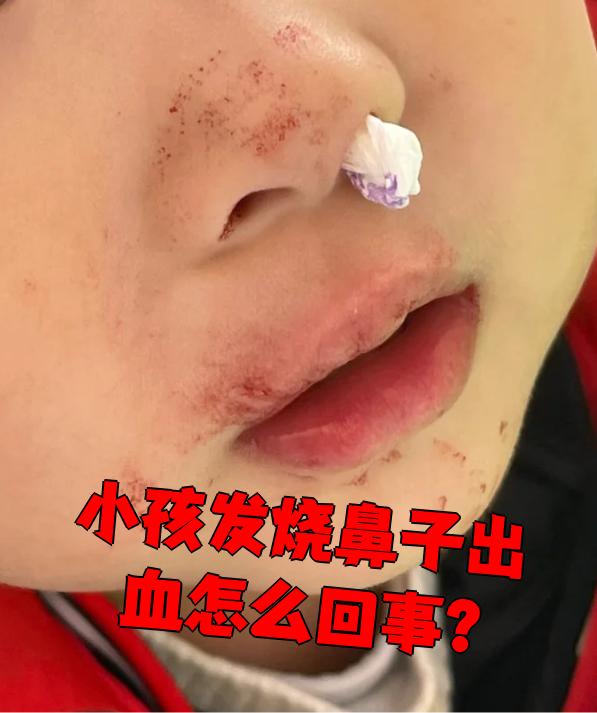 儿童鼻子出血怎么回事