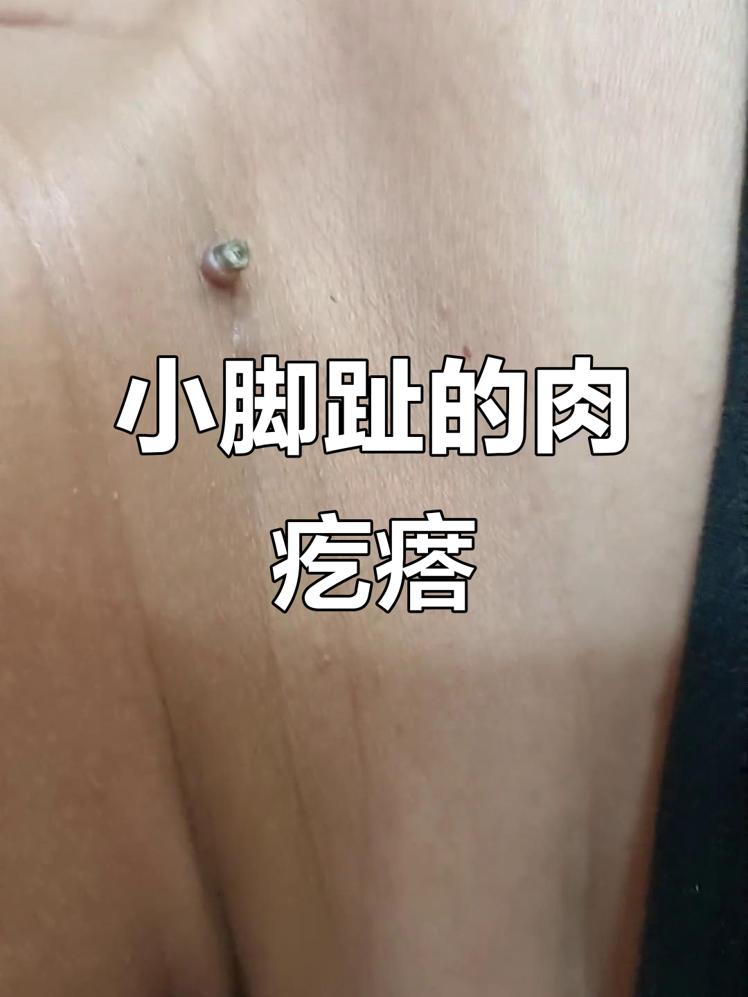 皮肤长出肉疙瘩