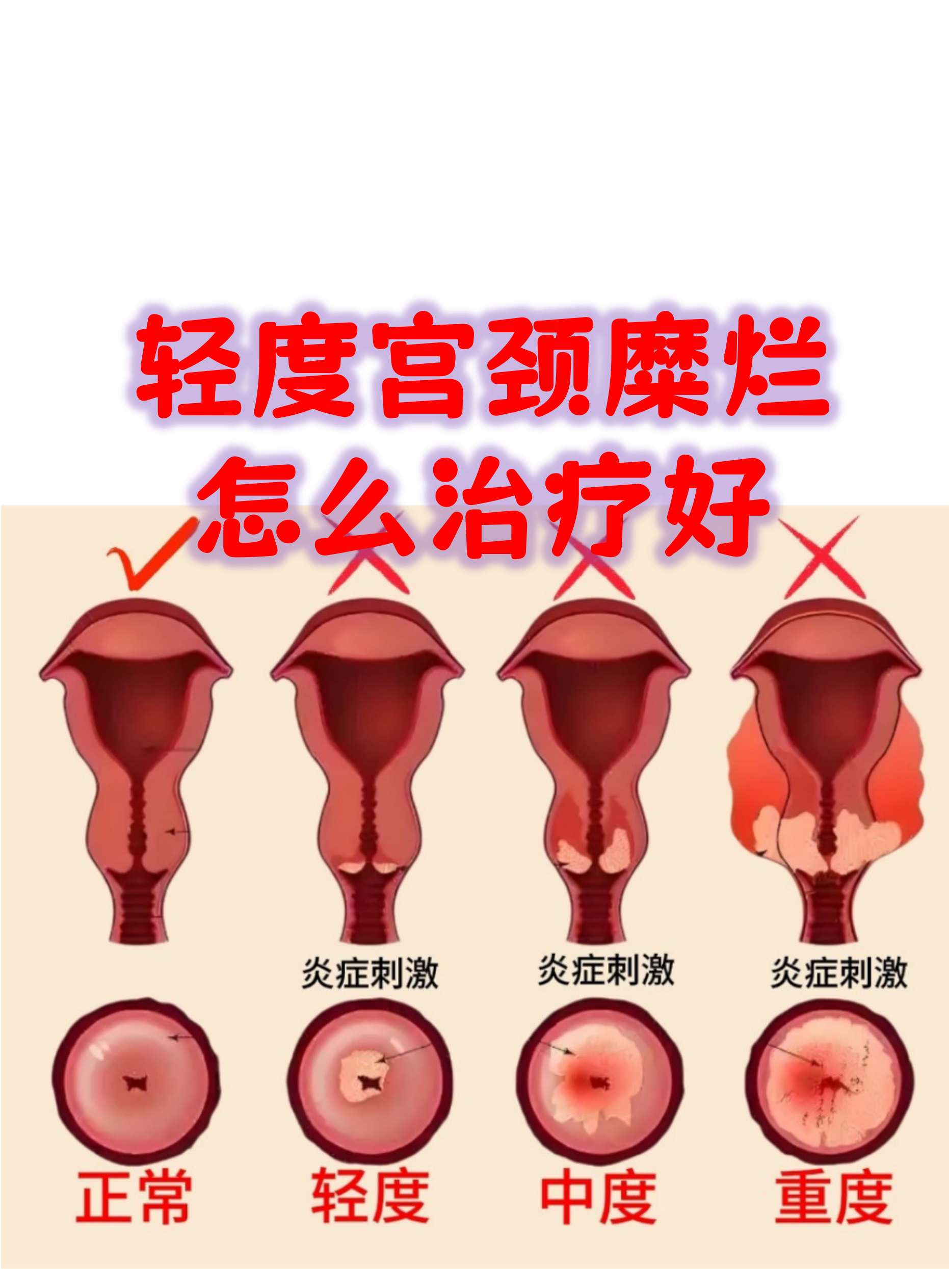 重度宫颈糜烂的症状有哪些?
