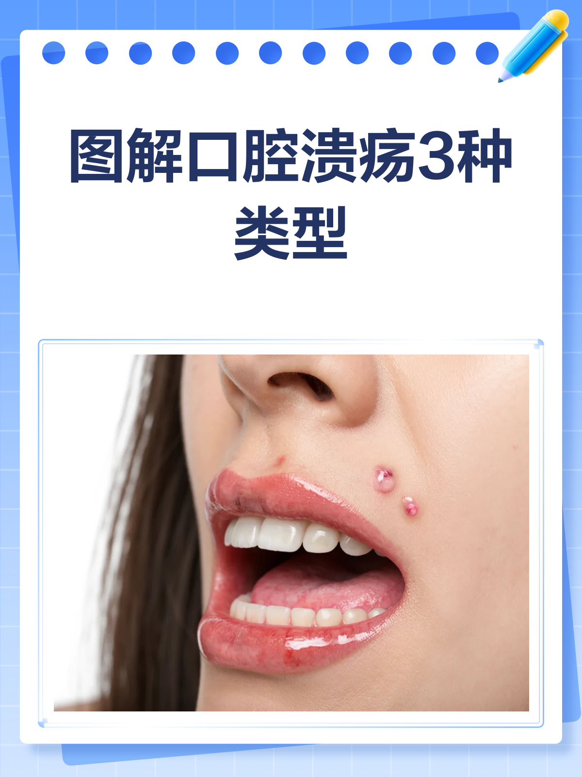 口腔溃疡的症状有哪些