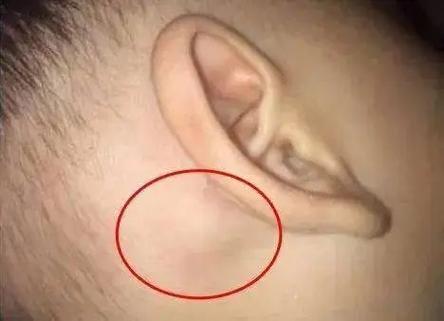 耳廓软骨上有个硬疙瘩