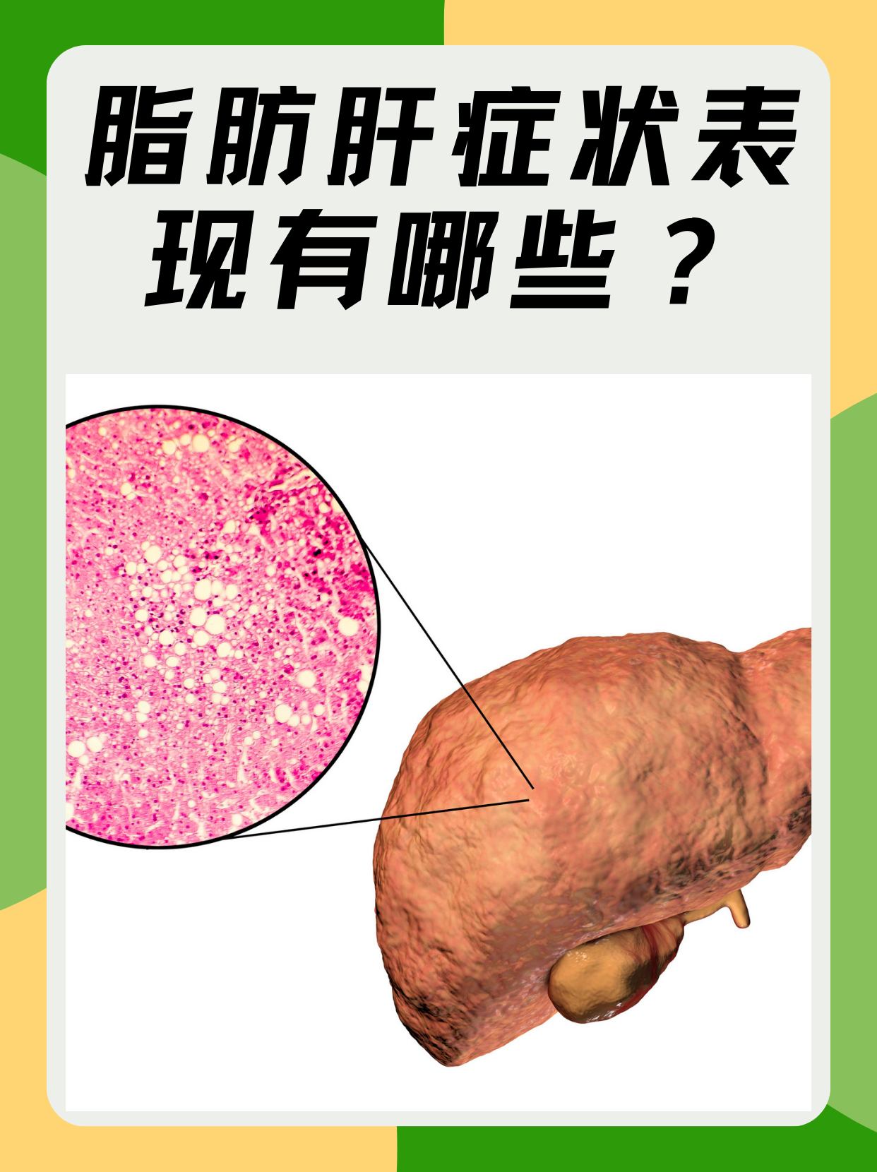 脂肪肝的症状有哪些?