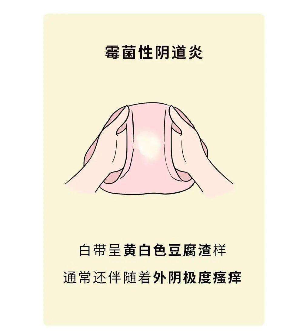 细菌性阴道炎能自愈吗