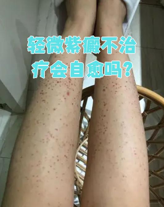 过敏性紫癜能自愈吗!!?