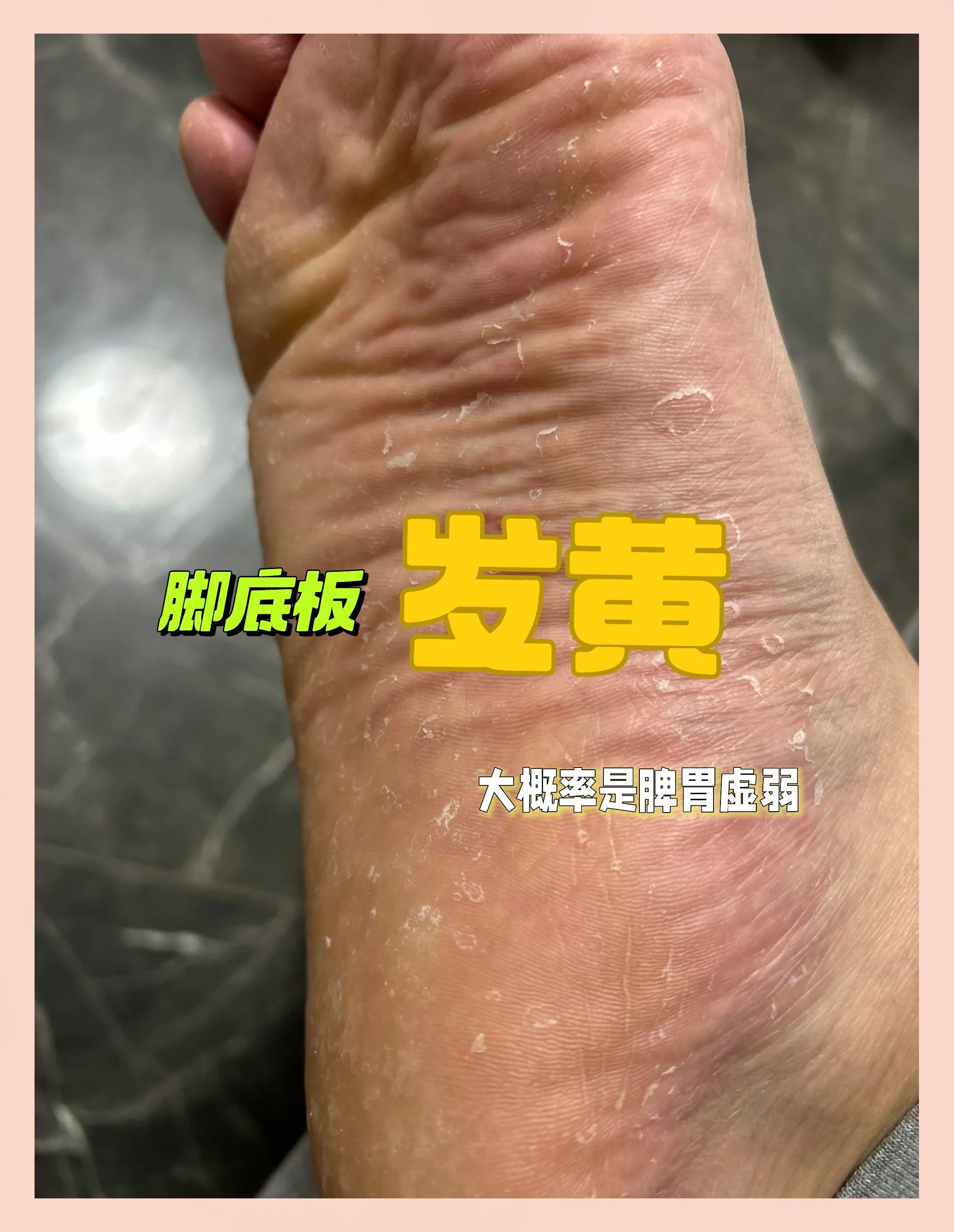 脚趾甲变黄变厚怎么回事?