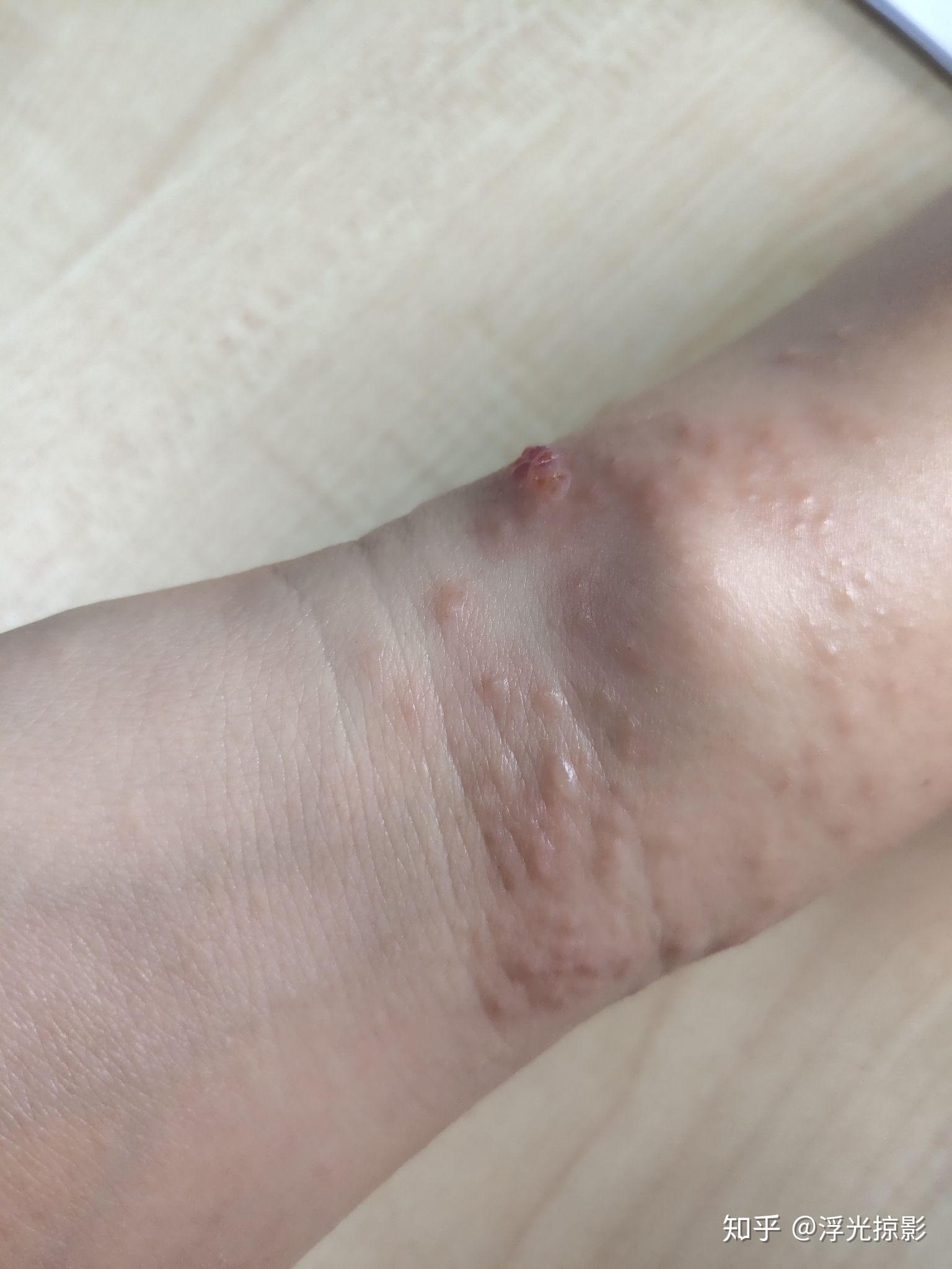 被毛毛虫咬了怎么处理