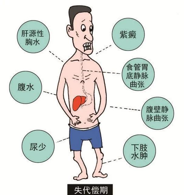 慢性乙肝的症状有哪些