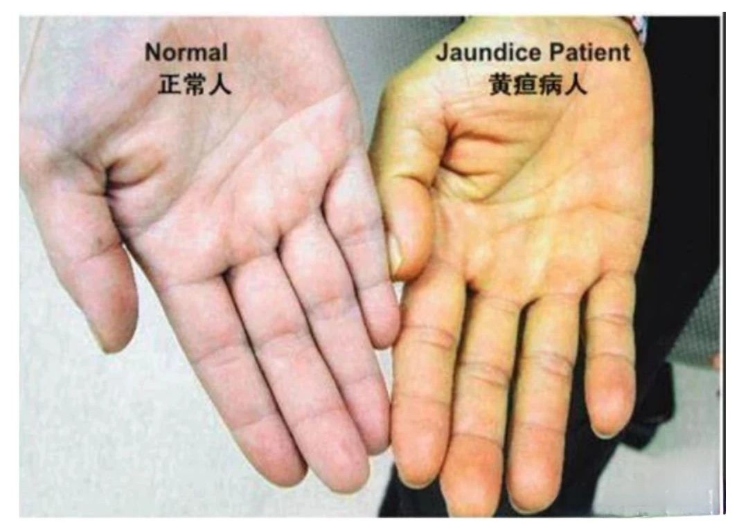手心发黄是什么原因引起的