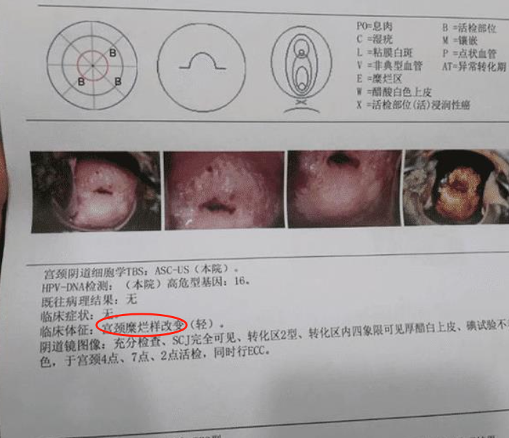 宫颈糜烂二度是什么意思