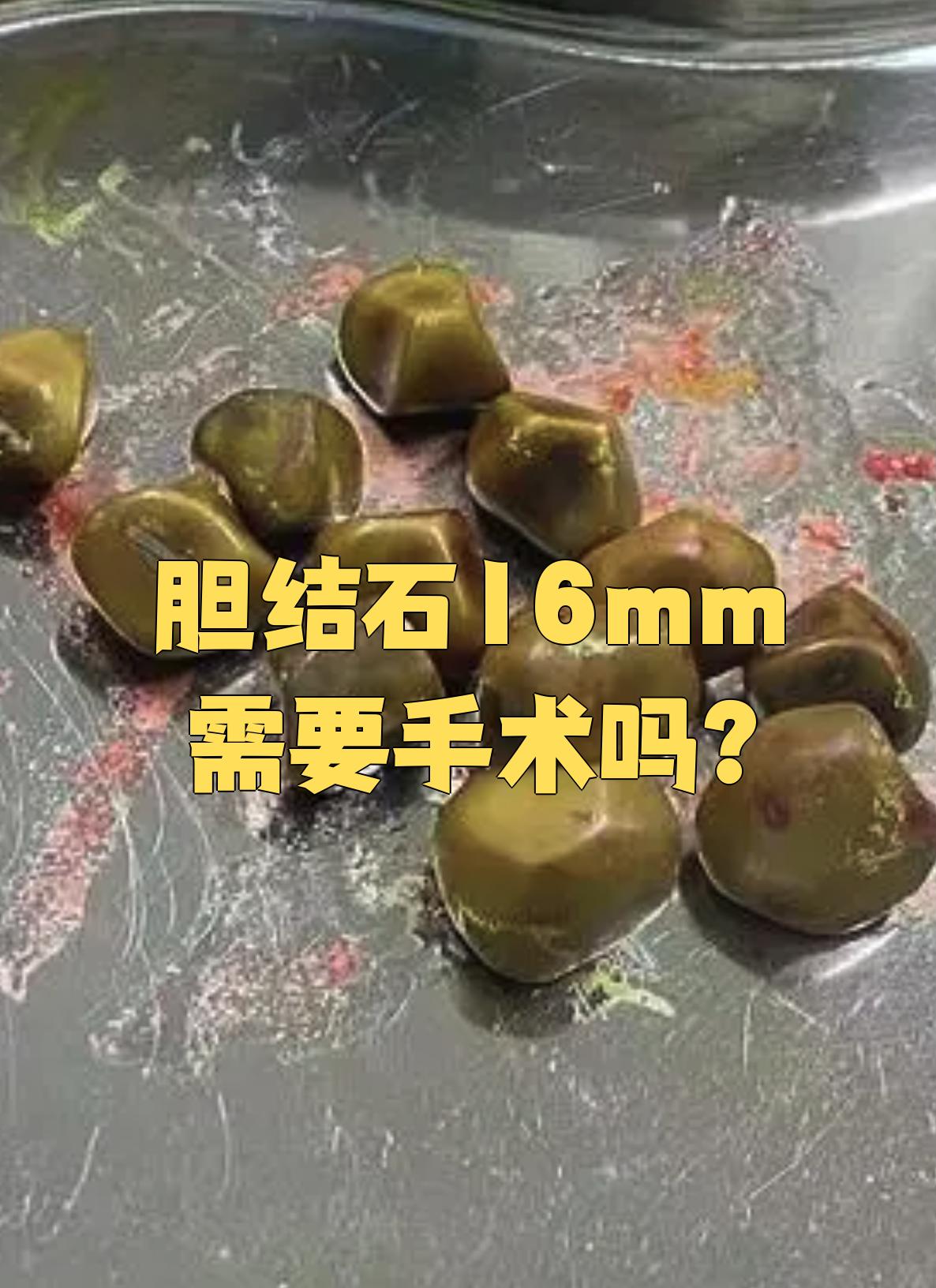 胆囊结石多大要做手术